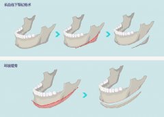 下頜角磨骨切除多少錢 國內(nèi)磨骨整形價格表