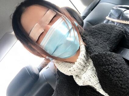 上海韓鏡割雙眼皮一個(gè)月