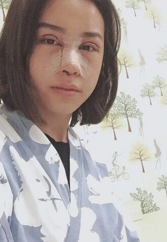 上海韓鏡網(wǎng)紅套餐半個月經(jīng)歷 雙眼皮多項整形+隆鼻整形+脂肪填充