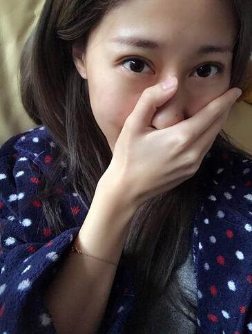 埋線雙眼皮七天恢復(fù)圖