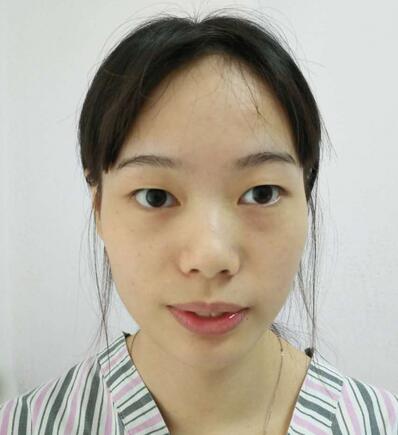 深圳晨曦三點定位雙眼皮日記