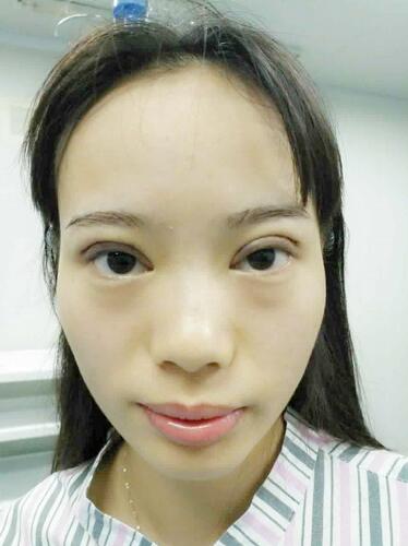 深圳晨曦三點定位雙眼皮日記