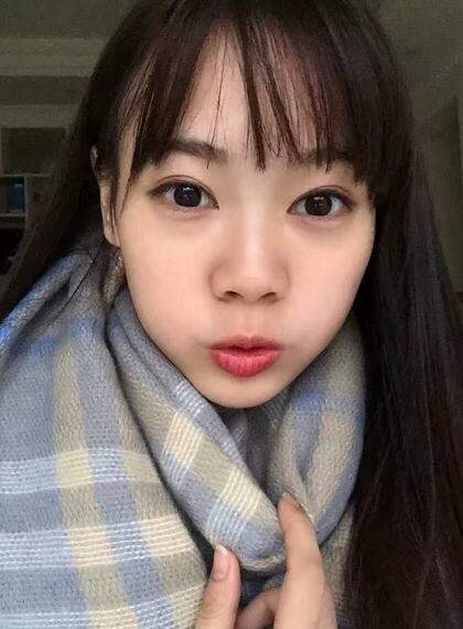 深圳晨曦三點定位雙眼皮日記