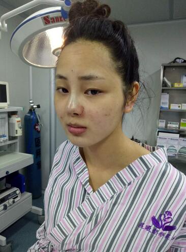 深圳晨曦隆鼻整形半年了 看看果