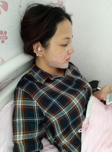 深圳晨曦隆鼻整形半年了 看看果