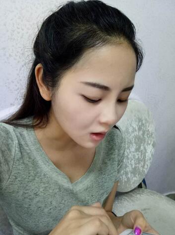 深圳晨曦隆鼻整形半年了 看看果