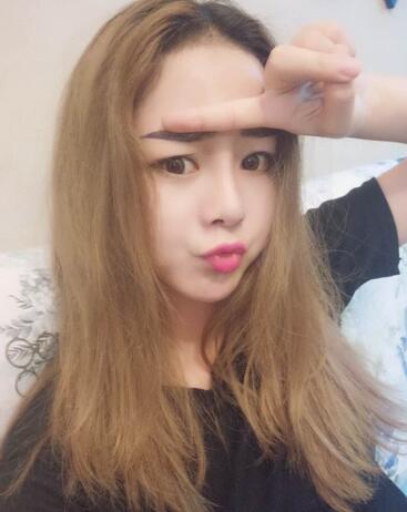 深圳晨曦隆鼻整形半年了 看看果