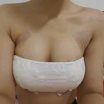 自體脂肪豐胸對(duì)比圖 抽脂隆胸十天