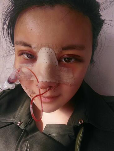 假體隆鼻兩個月后的感覺 隆鼻整形手術(shù)恢復(fù)日記