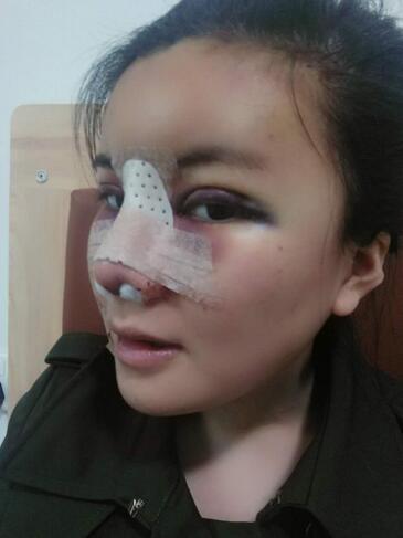 假體隆鼻兩個月后的感覺 隆鼻整形手術(shù)恢復(fù)日記