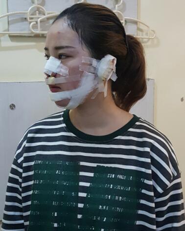 假體墊下巴一個(gè)月 前后對(duì)比