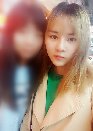 假體墊下巴一個(gè)月 前后對(duì)比