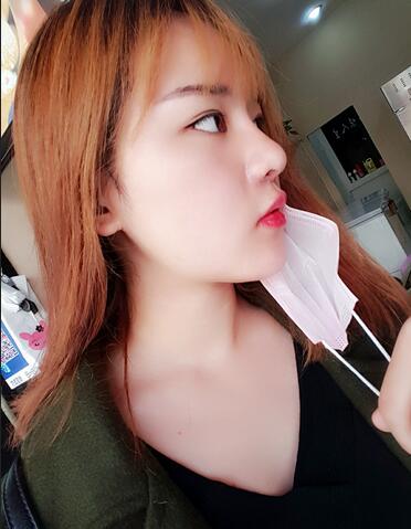 假體墊下巴一個(gè)月 前后對(duì)比