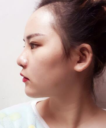 假體墊下巴一個(gè)月 前后對(duì)比