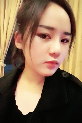 假體墊下巴一個(gè)月 前后對(duì)比