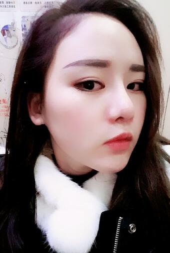 假體墊下巴一個(gè)月 前后對(duì)比