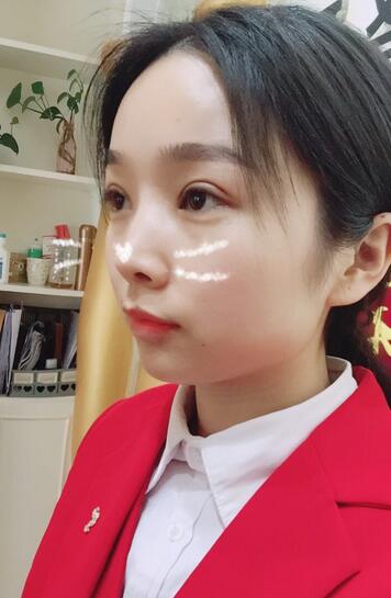 全切雙眼皮1個月過程圖