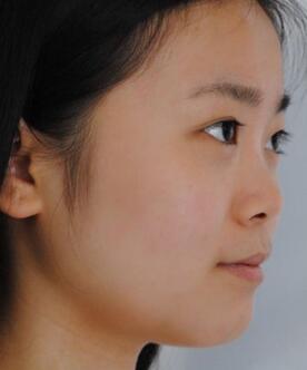 隆鼻整形日記 重慶鉑生硅膠隆鼻＋耳軟骨鼻尖