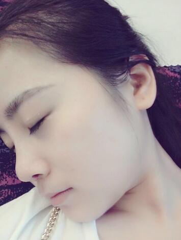 隆鼻整形日記 重慶鉑生硅膠隆鼻＋耳軟骨鼻尖