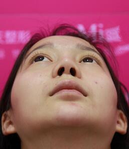 隆鼻修復(fù)術(shù)后恢復(fù)期經(jīng)歷