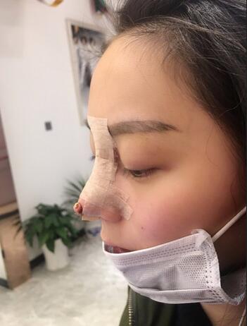 隆鼻修復(fù)術(shù)后恢復(fù)期經(jīng)歷