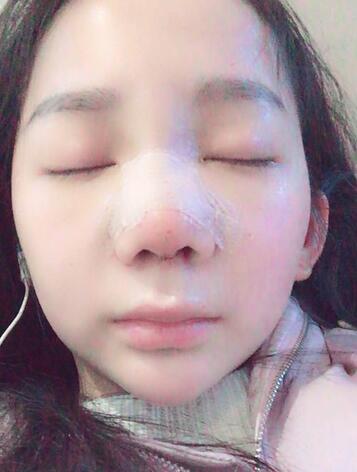 隆鼻修復(fù)術(shù)后恢復(fù)期經(jīng)歷