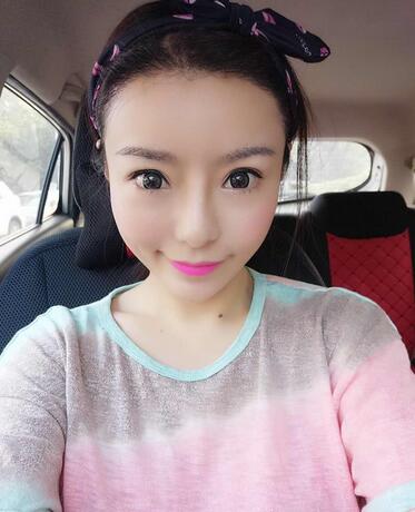 發(fā)際線調(diào)整案例分享 北京熙朵發(fā)際線+眉毛種植