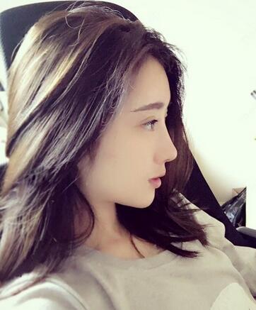 雙眼皮修復(fù)+自體脂肪填充恢復(fù)日記