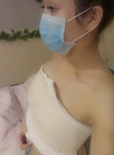 自體脂肪隆胸2個(gè)月經(jīng)歷