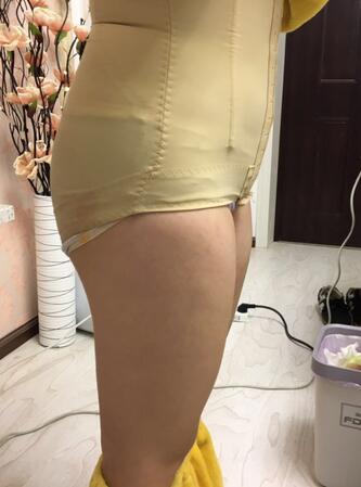 腰腹部吸脂后一個月照片