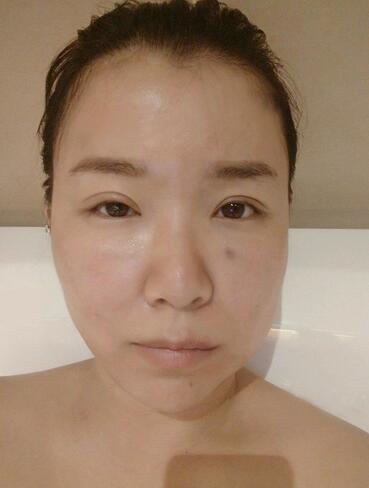 面部埋x幾天很好的果 恢復經(jīng)歷分享