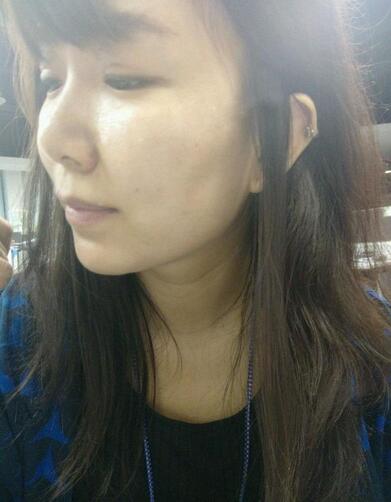 面部埋x幾天很好的果 恢復經(jīng)歷分享