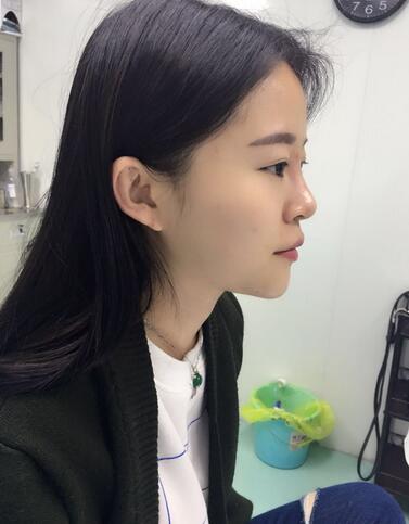 玻尿酸隆鼻恢復(fù)過程圖