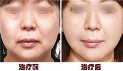 做蛋白線面b提升成好嗎、可以保持多久