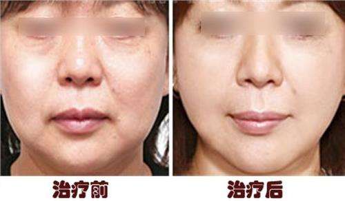 做蛋白線面b提升成好嗎、可以保持多久