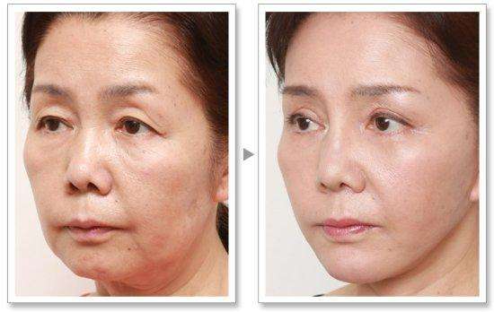 做蛋白線面b提升成好嗎、可以保持多久