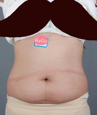 腰腹抽脂3個(gè)月的感受