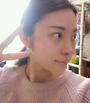 隆鼻整形1個(gè)月真實(shí)恢復(fù)期圖片