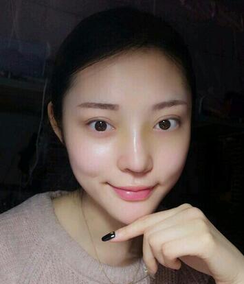 隆鼻整形1個(gè)月真實(shí)恢復(fù)期圖片