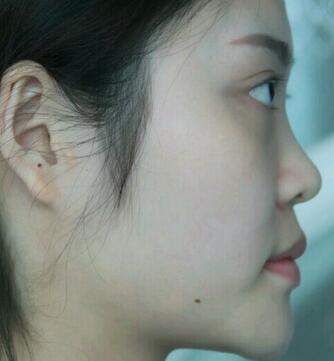 隆鼻整形1個(gè)月真實(shí)恢復(fù)期圖片