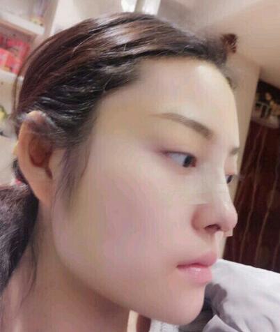 隆鼻整形1個(gè)月真實(shí)恢復(fù)期圖片