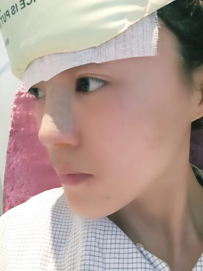 鼻子做完假體12天恢復(fù)圖