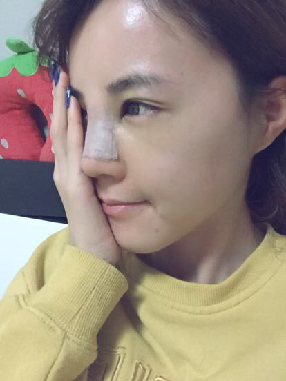 鼻子做完假體12天恢復(fù)圖