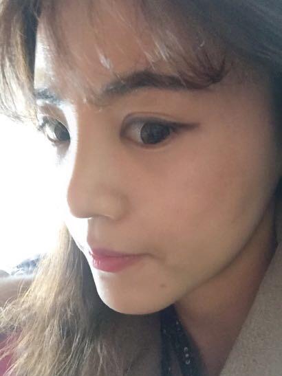 鼻子做完假體12天恢復(fù)圖