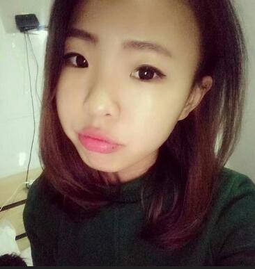 割雙眼皮術(shù)后恢復(fù)過程 全切雙眼皮3個月