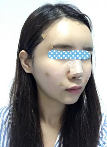 自體脂肪填充后2個月圖