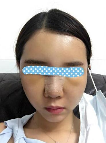 自體脂肪填充后2個月圖