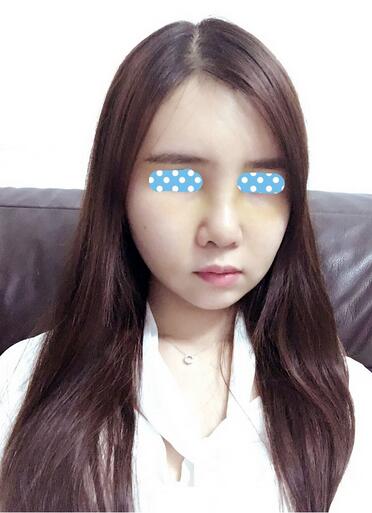 自體脂肪填充后2個月圖