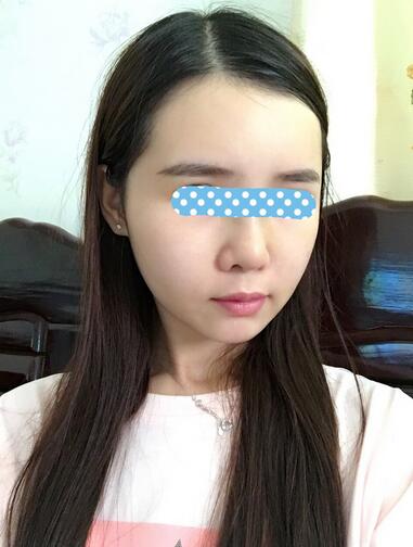 自體脂肪填充后2個月圖