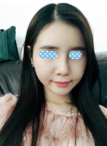 自體脂肪填充后2個月圖